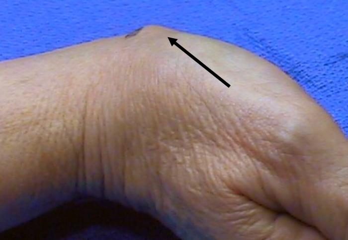 ganglion-base-of-thumb